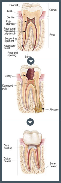 Root Canal Treatment Tooth Diagram