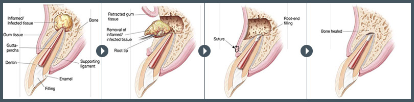 Endodontic Retreatment and Endodontic Surgery